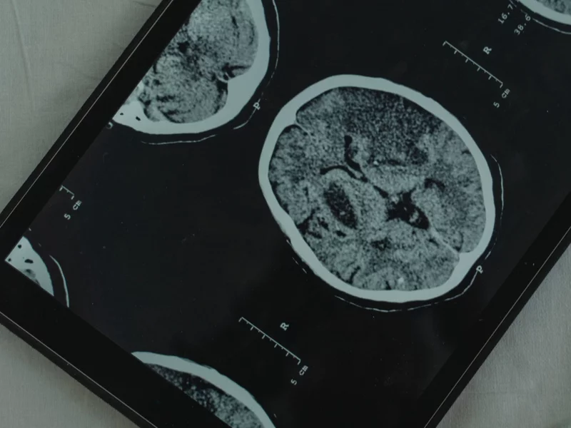 Mózg seniorów zaskakuje naukowców. Przełom w walce z chorobą Alzheimera?